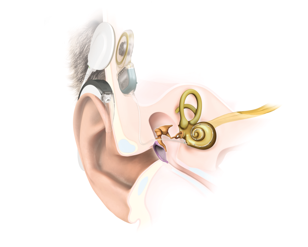 Das Cochlea-Implantat